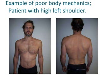     Example of poor body mechanics;      Patient with high left shoulder.       