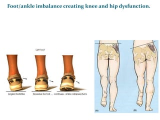      Foot/ankle imbalance creating knee and hip dysfunction.