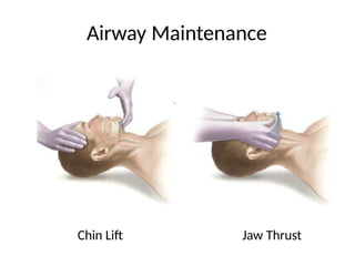 Airway Maintenance
Chin Lift Jaw Thrust
 