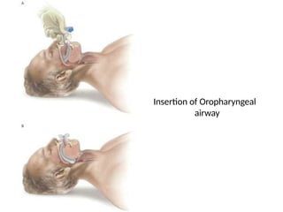 Insertion of Oropharyngeal
airway
 