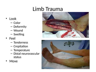 Limb Trauma
• Look
– Color
– Deformity
– Wound
– Swelling
• Feel
– Tenderness
– Crepitation
– Temperature
– Distal neurovascular
status
• Move
 