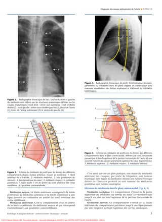 Masses mediastinales | PDF