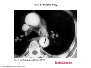 Figure 9. Bronchial artery.
Yoon W et al. Radiographics 2002;22:1395-1409
©2002 by Radiological Society of North America
 