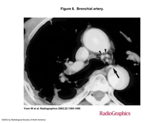 Figure 8. Bronchial artery.
Yoon W et al. Radiographics 2002;22:1395-1409
©2002 by Radiological Society of North America
 