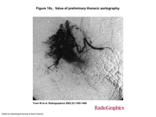 Figure 10c. Value of preliminary thoracic aortography.
Yoon W et al. Radiographics 2002;22:1395-1409
©2002 by Radiological Society of North America
 
