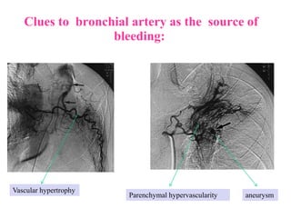 Clues to bronchial artery as the source of
bleeding:
Parenchymal hypervascularity
Vascular hypertrophy
aneurysm
 