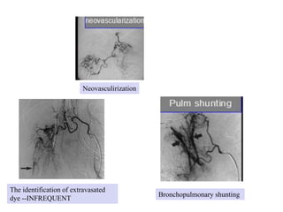 The identification of extravasated
dye --INFREQUENT
Bronchopulmonary shunting
Neovasculirization
 