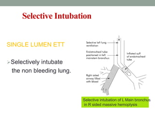 Selective Intubation
SINGLE LUMEN ETT
Selectively intubate
the non bleeding lung.
Selective intubation of L Main bronchus
in R sided massive hemoptysis
 