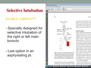 Selective Intubation
DOUBLE LUMEN ETT
Specially designed for
selective intubation of
the right or left main
bronchi
Last option in an
asphyxiating pt.
 