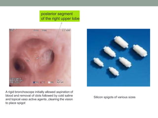 A rigid bronchoscope initially allowed aspiration of
blood and removal of clots followed by cold saline
and topical vaso active agents ,clearing the vision
to place spigot
posterior segment
of the right upper lobe
Silicon spigots of various sizes
 