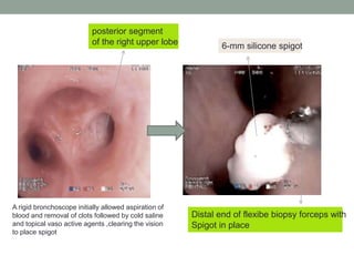 Distal end of flexibe biopsy forceps with
Spigot in place
6-mm silicone spigot
posterior segment
of the right upper lobe
A rigid bronchoscope initially allowed aspiration of
blood and removal of clots followed by cold saline
and topical vaso active agents ,clearing the vision
to place spigot
 