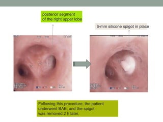 Following this procedure, the patient
underwent BAE, and the spigot
was removed 2 h later.
6-mm silicone spigot in place
posterior segment
of the right upper lobe
 