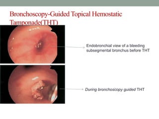 Bronchoscopy-Guided Topical Hemostatic
Tamponade(THT)
Endobronchial view of a bleeding
subsegmental bronchus before THT
During bronchoscopy guided THT
 
