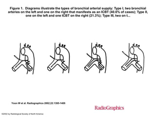 Figure 1. Diagrams illustrate the types of bronchial arterial supply: Type I, two bronchial
arteries on the left and one on the right that manifests as an ICBT (40.6% of cases); Type II,
one on the left and one ICBT on the right (21.3%); Type III, two on t...
Yoon W et al. Radiographics 2002;22:1395-1409
©2002 by Radiological Society of North America
 