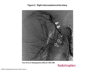 Figure 2. Right intercostobronchial artery.
Yoon W et al. Radiographics 2002;22:1395-1409
©2002 by Radiological Society of North America
 