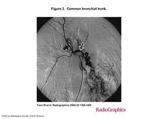 Figure 3. Common bronchial trunk.
Yoon W et al. Radiographics 2002;22:1395-1409
©2002 by Radiological Society of North America
 