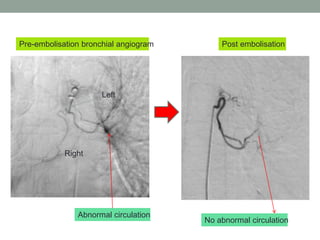 Right
Left
Abnormal circulation
Pre-embolisation bronchial angiogram
No abnormal circulation
Post embolisation
 