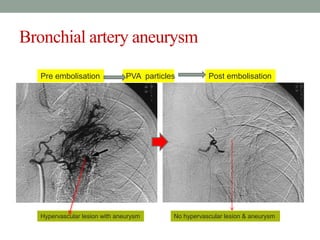 Bronchial artery aneurysm
Hypervascular lesion with aneurysm
Pre embolisation Post embolisationPVA particles
No hypervascular lesion & aneurysm
 