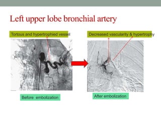 Left upper lobe bronchial artery
After embolization
Decreased vascularity & hypertrophyTortous and hypertrophied vessel
Before embolization
 
