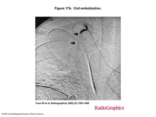 Figure 17b. Coil embolization.
Yoon W et al. Radiographics 2002;22:1395-1409
©2002 by Radiological Society of North America
 