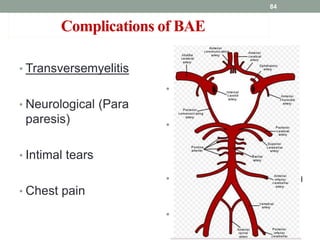 Complications of BAE
• Transversemyelitis
• Neurological (Para
paresis)
• Intimal tears
• Chest pain
• Pyrexia
• Haemoptysis
• Systemic embolisation
• Vessel perforation
84
 