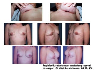 Prophilactic subcutaneous mastectomy sequeal:
case report Cir.plást. iberolatinoam. - Vol. 34 - Nº 4
 