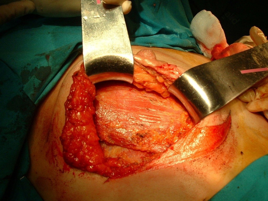 Fotos Mastectomía Con Reconstrucción Inmediata Mastectomía subcutánea