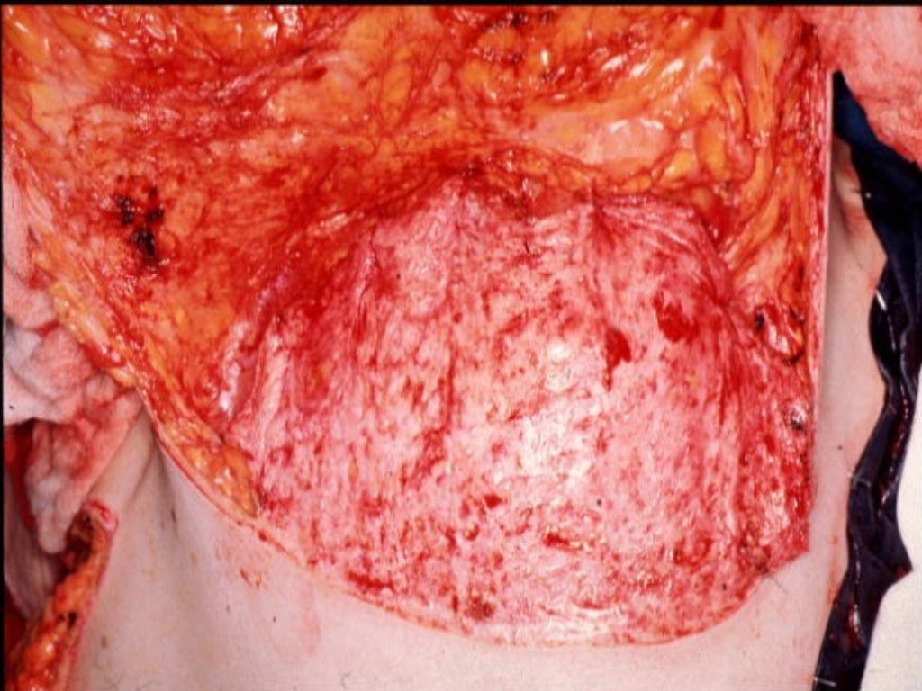 Fotos Mastectomía Con Reconstrucción Inmediata Mastectomía subcutánea