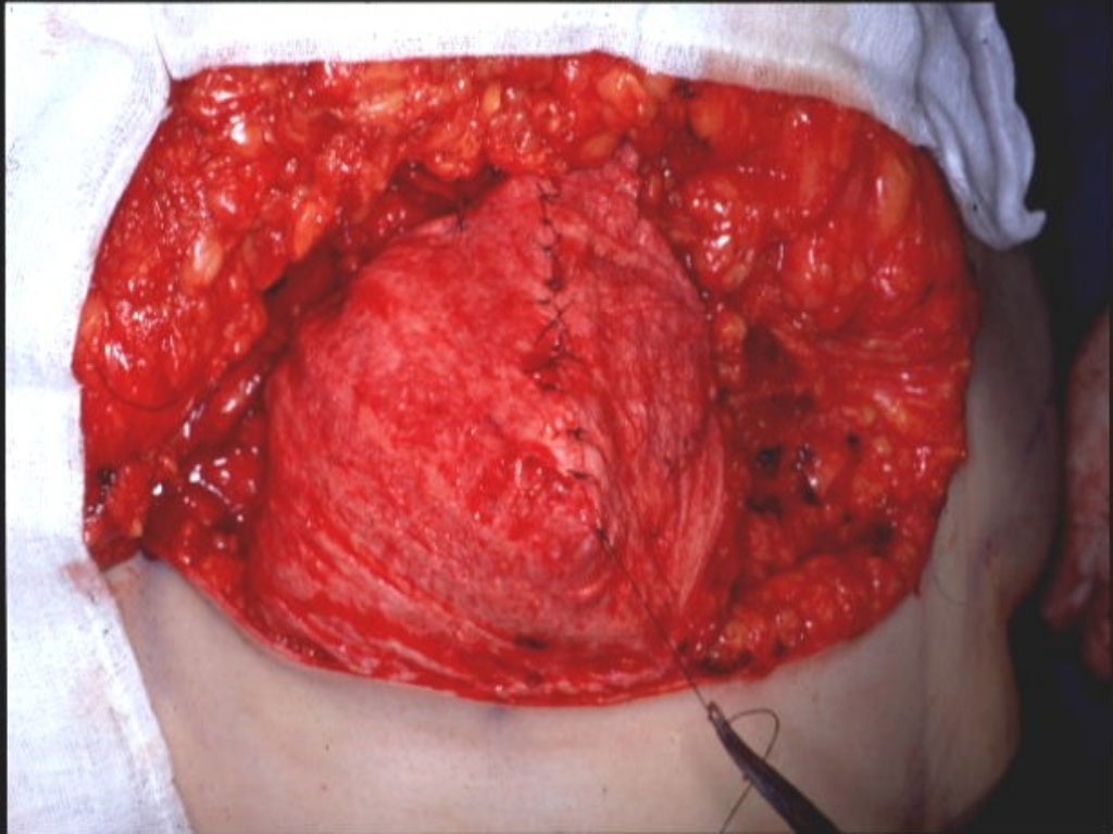Fotos Mastectomía Con Reconstrucción Inmediata Mastectomía subcutánea