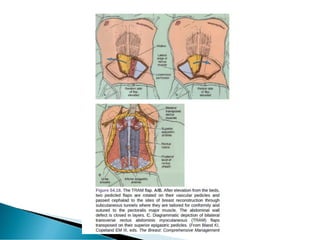 Orr Incision Mastectomy | PDF