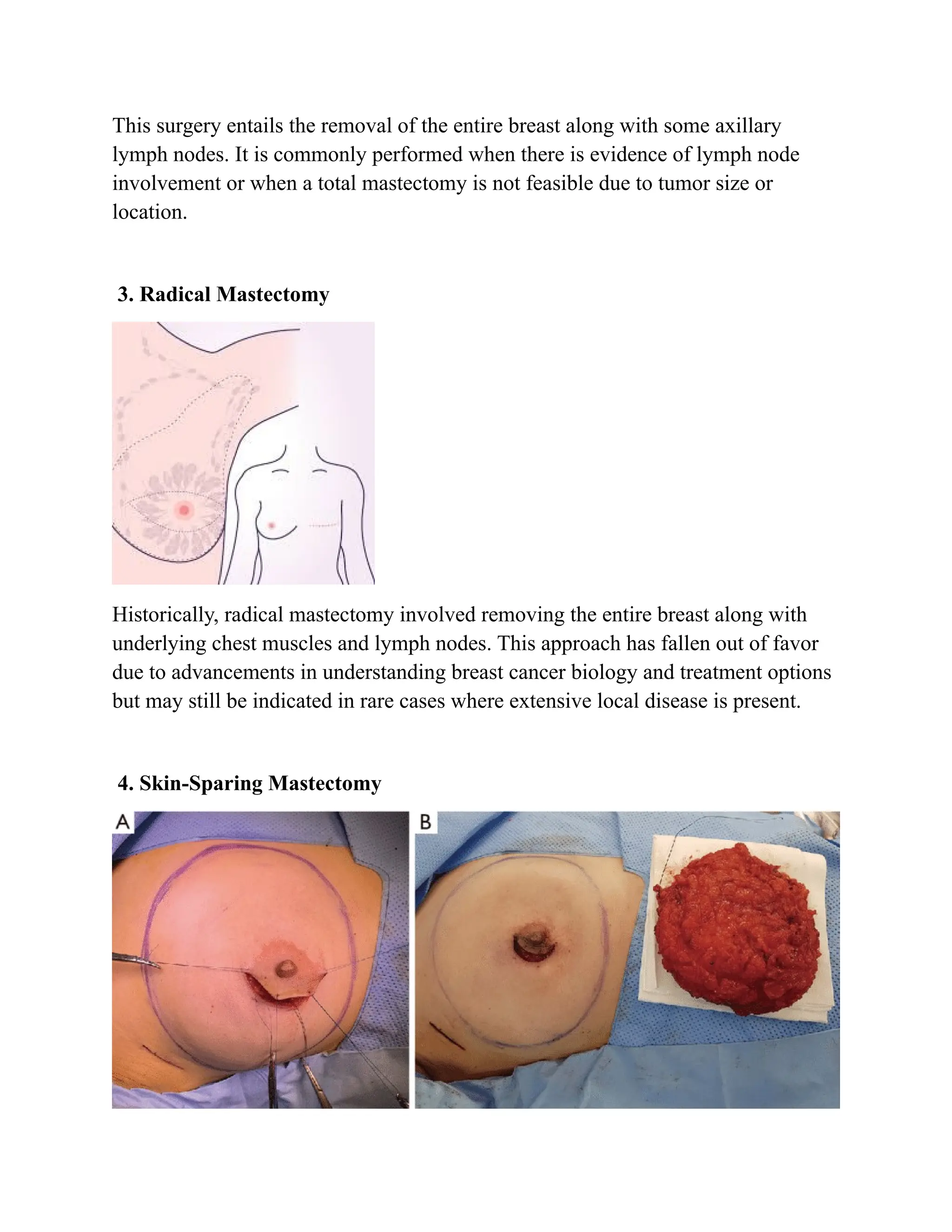 Masterctomy Types mastectomy and oncosurgery- definition, types ..... | DOCX