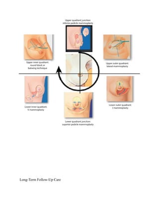 Masterctomy Types mastectomy and oncosurgery- definition, types ..... | DOCX