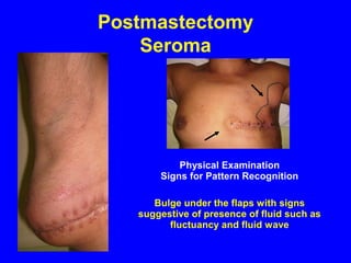 Postmastectomy
Seroma
Physical Examination
Signs for Pattern Recognition
Bulge under the flaps with signs
suggestive of presence of fluid such as
fluctuancy and fluid wave
 
