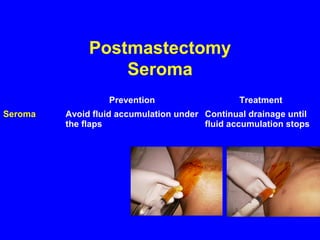 Postmastectomy
Seroma
Prevention Treatment
Seroma Avoid fluid accumulation under
the flaps
Continual drainage until
fluid accumulation stops
 