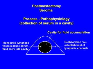 Postmastectomy
Seroma
Process - Pathophysiology
(collection of serum in a cavity)
Reabsorption / re-
establishment of
lymphatic channels
Cavity for fluid accumulation
Transected lymphatic
vessels cause serum
fluid entry into cavity
 