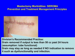 Mastectomy Morbidities: SEROMA
Prevention and Treatment Management Principles
Division’s Recommended Practice:
Drain removed if output is less than 50 cc past 24 hours
(assumption: tube functional)
Drain may stay as long as needed if NO indication to remove
it such as dysfunctionality and infection.
 