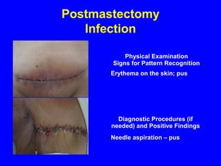 Postmastectomy
Infection
Physical Examination
Signs for Pattern Recognition
Erythema on the skin; pus
Diagnostic Procedures (if
needed) and Positive Findings
Needle aspiration – pus
 