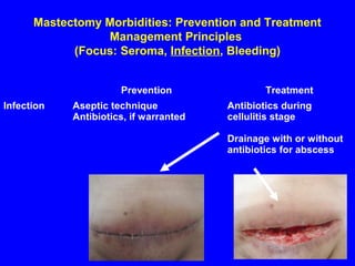 Mastectomy Morbidities: Prevention and Treatment
Management Principles
(Focus: Seroma, Infection, Bleeding)
Prevention Treatment
Infection Aseptic technique
Antibiotics, if warranted
Antibiotics during
cellulitis stage
Drainage with or without
antibiotics for abscess
 