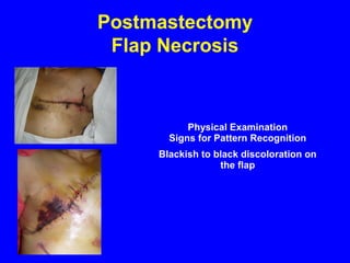 Postmastectomy
Flap Necrosis
Physical Examination
Signs for Pattern Recognition
Blackish to black discoloration on
the flap
 