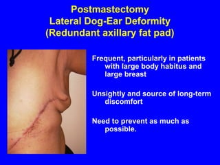 Postmastectomy
Lateral Dog-Ear Deformity
(Redundant axillary fat pad)
Frequent, particularly in patients
with large body habitus and
large breast
Unsightly and source of long-term
discomfort
Need to prevent as much as
possible.
 