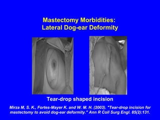 Mastectomy Morbidities:
Lateral Dog-ear Deformity
Tear-drop shaped incision
Mirza M, S. K., Fortes-Mayer K. and W. M. H. (2003). "Tear-drop incision for
mastectomy to avoid dog-ear deformity." Ann R Coll Surg Engl. 85(2):131.
 