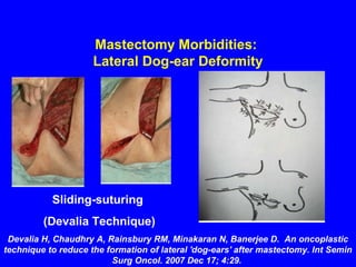 Mastectomy Morbidities:
Lateral Dog-ear Deformity
Sliding-suturing
(Devalia Technique)
Devalia H, Chaudhry A, Rainsbury RM, Minakaran N, Banerjee D. An oncoplastic
technique to reduce the formation of lateral 'dog-ears' after mastectomy. Int Semin
Surg Oncol. 2007 Dec 17; 4:29.
 