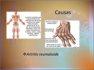 Los pacientes con miastenia grave tienen un riesgo de presentar otros trastornos autoinmunes  como:Causas Tirotoxicosis