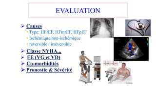 ➢ Causes
• Type: HFrEF, HFmrEF, HFpEF
• Ischémique/non-ischémique
• réversible / irréversible
➢ Classe NYHA...
➢ FE (VG et VD)
➢ Co-morbidités
➢ Pronostic & Sévérité
EVALUATION
 