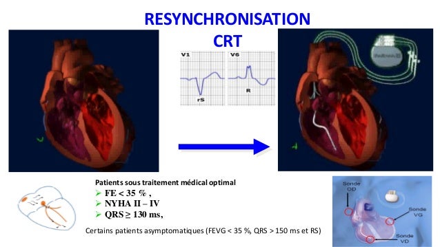 Master class hf 2017 Traitement de l'Insuffisance cardiaque