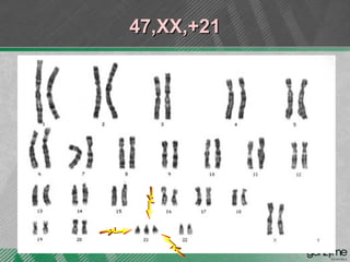 47,XX,+21 