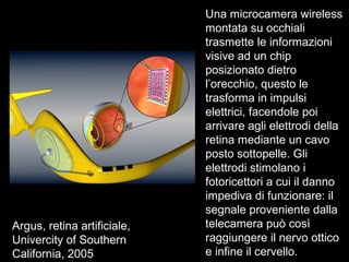 Argus, retina artificiale,
Univercity of Southern
California, 2005
Una microcamera wireless
montata su occhiali
trasmette le informazioni
visive ad un chip
posizionato dietro
l’orecchio, questo le
trasforma in impulsi
elettrici, facendole poi
arrivare agli elettrodi della
retina mediante un cavo
posto sottopelle. Gli
elettrodi stimolano i
fotoricettori a cui il danno
impediva di funzionare: il
segnale proveniente dalla
telecamera può così
raggiungere il nervo ottico
e infine il cervello.
 