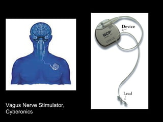 Vagus Nerve Stimulator,
Cyberonics
 