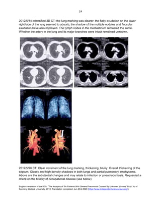 English translation of the MSc: "The Analysis of Six Patients With Severe Pneumonia Caused By Unknown Viruses" By Li Xu of
Kunming Medical University, 2013. Translation completed: Jun 23rd 2020 (https://www.independentsciencenews.org/)
	
	
24	
2012/5/14 intensified 3D CT: the lung marking was clearer: the flaky exudation on the lower
right lobe of the lung seemed to absorb, the shadow of the multiple nodules and floccular
exudation have also improved. The lymph nodes in the mediastinum remained the same.
Whether the artery in the lung and its major branches were intact remained unknown.
2012/5/26 CT: Clear increment of the lung marking, thickening, blurry. Overall thickening of the
septum. Glassy and high density shadows in both lungs and partial pulmonary emphysema.
Above are the substantial changes and may relate to infection or pneumoconiosis. Requested a
check on the history of occupational disease (see below)
 