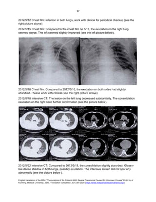English translation of the MSc: "The Analysis of Six Patients With Severe Pneumonia Caused By Unknown Viruses" By Li Xu of
Kunming Medical University, 2013. Translation completed: Jun 23rd 2020 (https://www.independentsciencenews.org/)
	
	
37	
2012/5/12 Chest film: infection in both lungs, work with clinical for periodical checkup (see the
right picture above)
2012/5/15 Chest film: Compared to the chest film on 5/13, the exudation on the right lung
seemed worse. The left seemed slightly improved (see the left picture below).
2012/5/18 Chest film: Compared to 2012/5/16, the exudation on both sides had slightly
absorbed. Please work with clinical (see the right picture above)
2012/5/18 Intensive CT: The lesion on the left lung decreased substantially. The consolidation
exudation on the right need further confirmation (see the picture below).
2012/5/22 intensive CT: Compared to 2012/5/18, the consolidation slightly absorbed. Glassy-
like dense shadow in both lungs, possibly exudation. The intensive screen did not spot any
abnormally (see the picture below ).
 